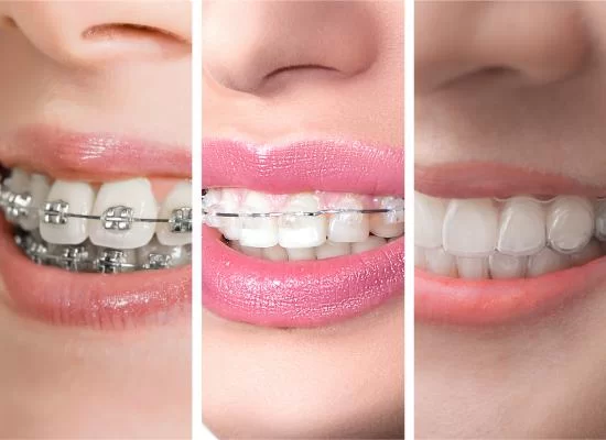 Does Invisalign Change Your FaceShape