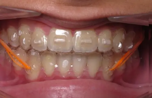 Invisalign Rubber Bands